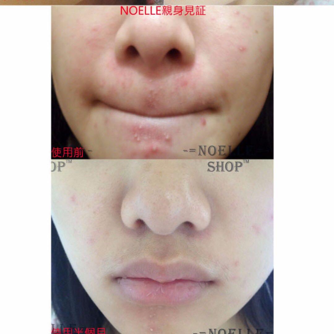 去痘去暗瘡1日消炎見效 含膿石頭瘡等都有效 無效退款 1天見效 植物精華去粉刺暗瘡去印豆膏霜 美容 化妝品 皮膚護理