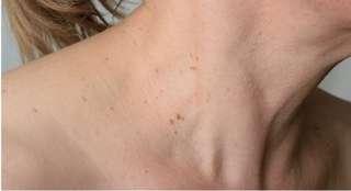Warts / Skin Tag  Removal Home Service