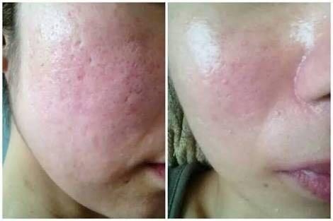 獨家 想改善凹凸洞 暗瘡肌 遊戲機 遊戲機遊戲 Carousell