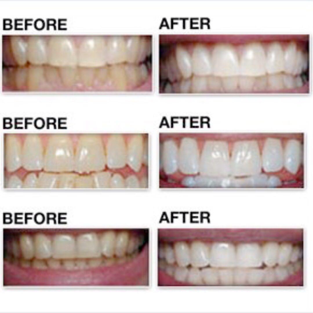 Полоски для отбеливания зубов до и после