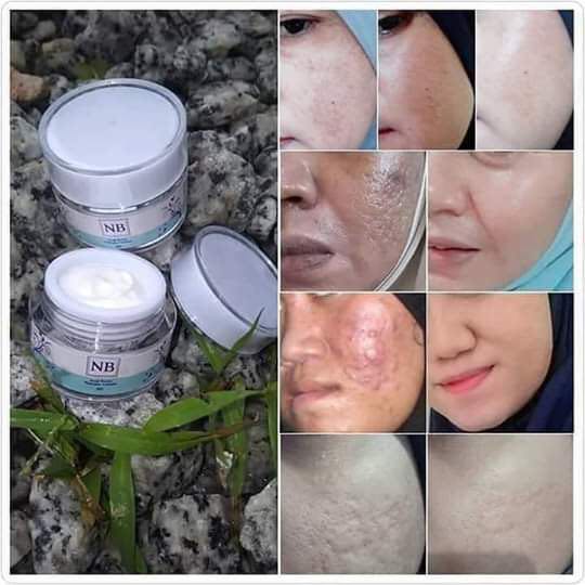 nb acne scar cream