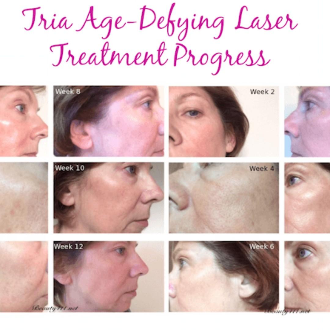 Tria age defying laser top