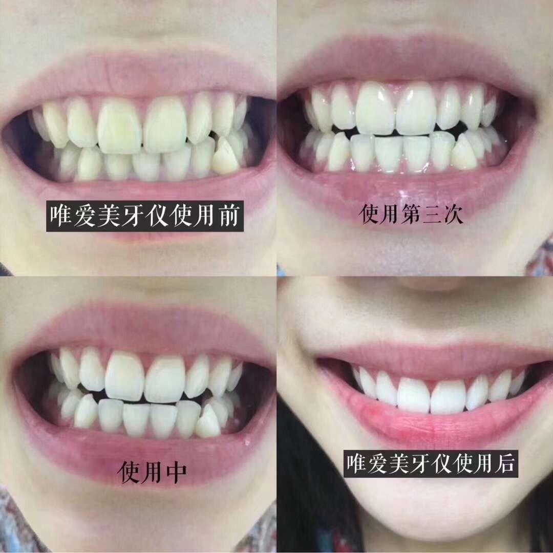 Viaila Teeth Whitening Kit, Beauty & Personal Care, Hands & Nails on