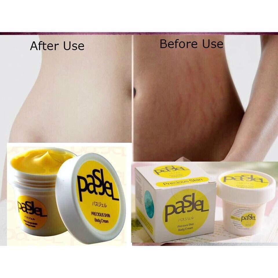 pasjel for stretch marks