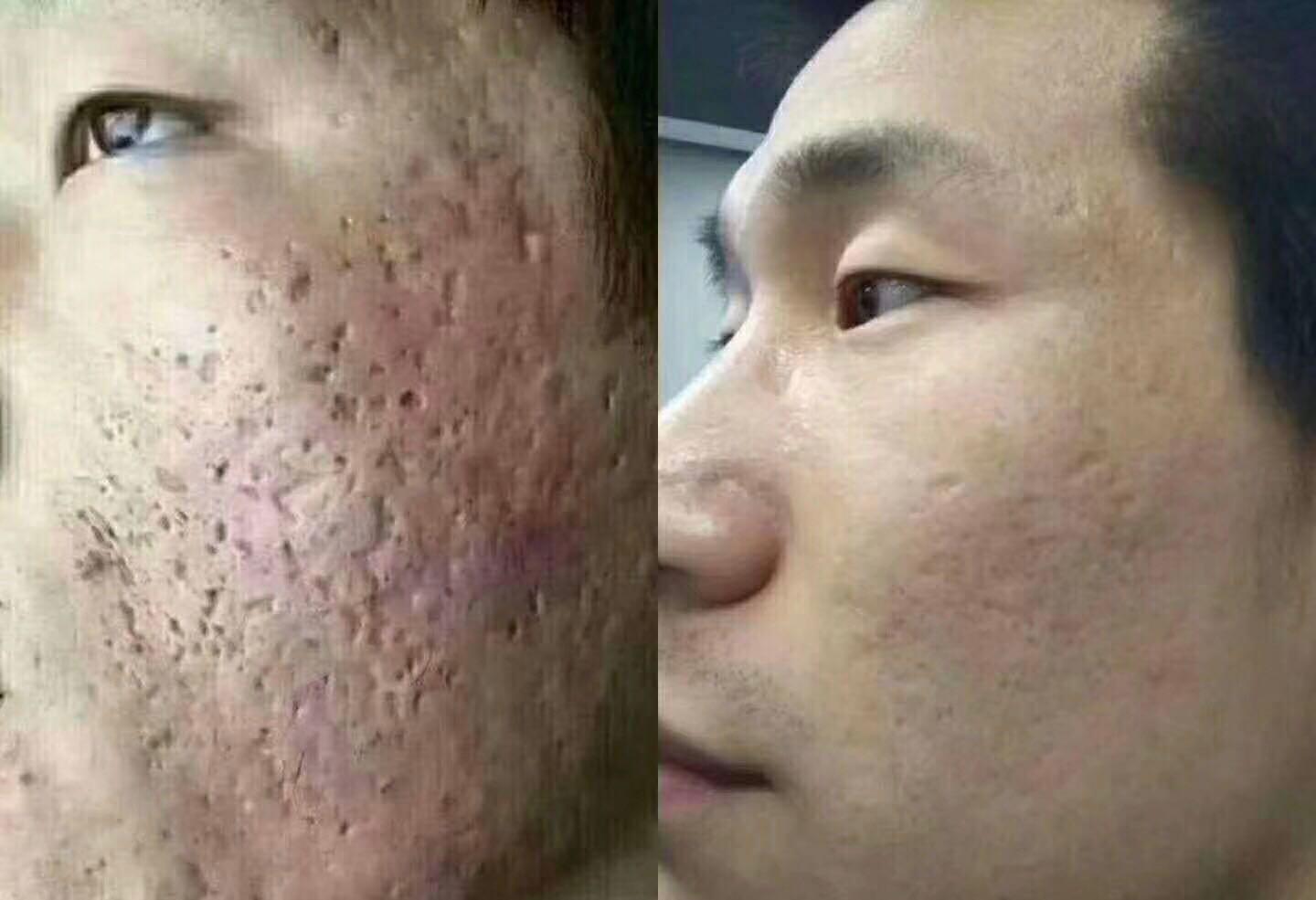 Acne Scars Treatment Lifestyle Services Beauty Health Services On Carousell
