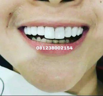 Veneer gigi