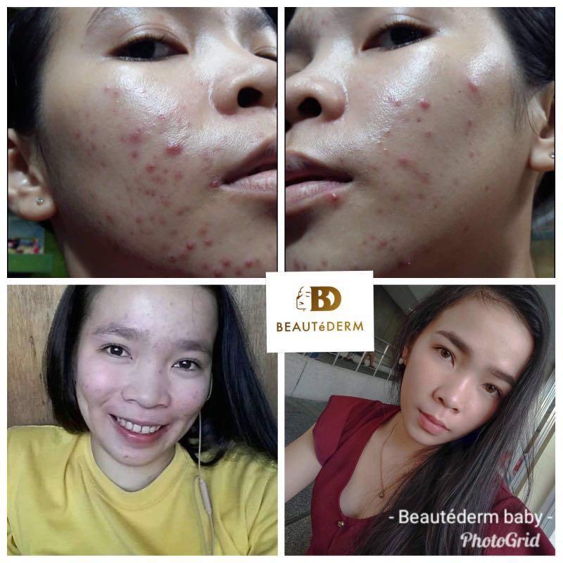beautederm for pimple marks