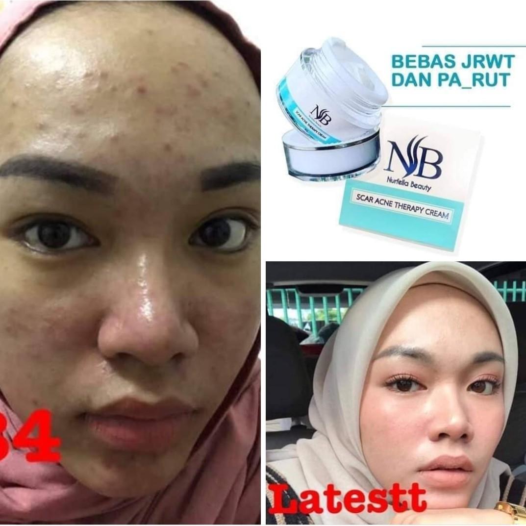 nb acne scar cream
