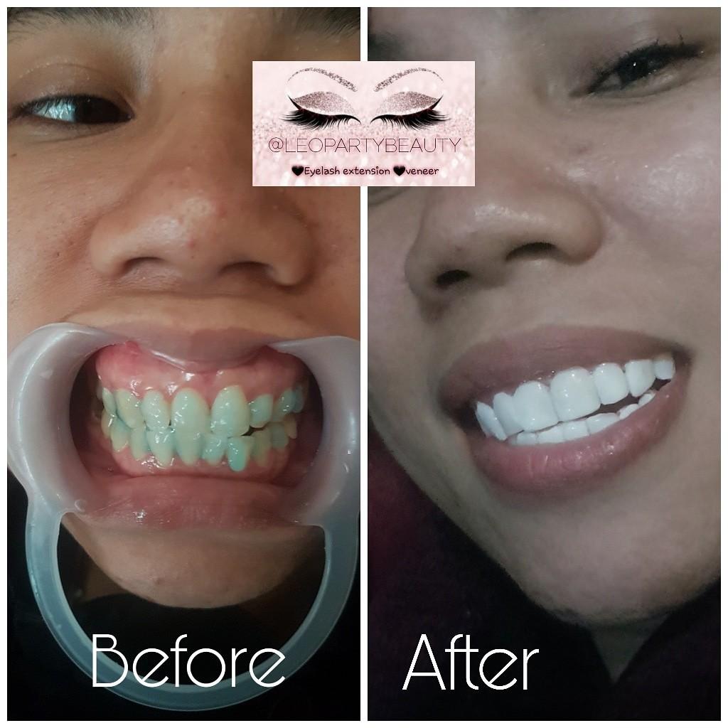 Veneer Veneers Gigi Whitening Tooth Bleaching Putih Pemutih Artis Kesehatan Kecantikan Kulit Sabun Tubuh Di Carousell