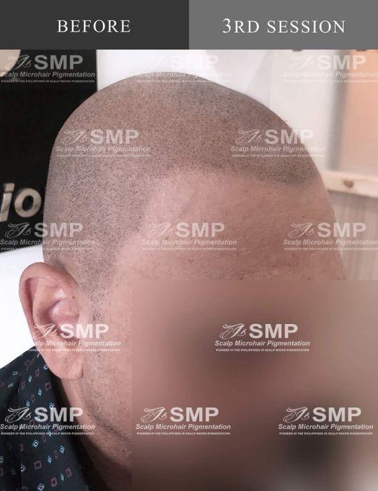 Smp Scalp Micropigmentation Not Hair Tattoo On Carousell