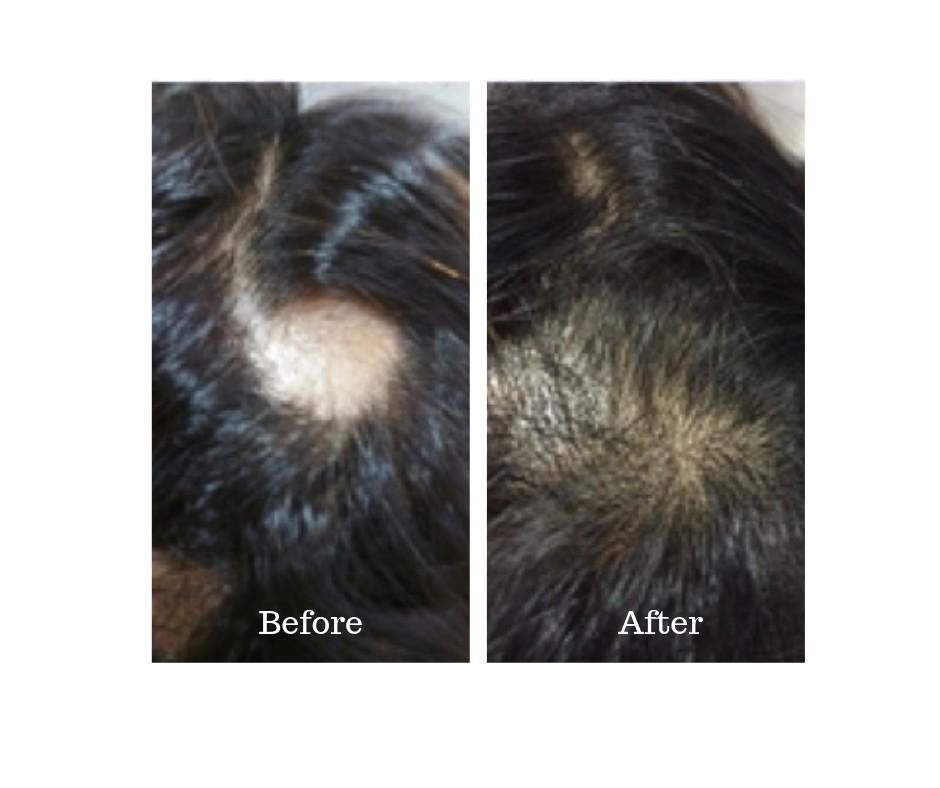 Treatment For Hair Loss Sensitive Itchy Oily Scalp Health