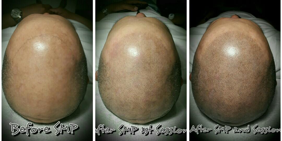 Scalp Micro Pigmentation Smp Not Your Ordinary Hair Tattoo On