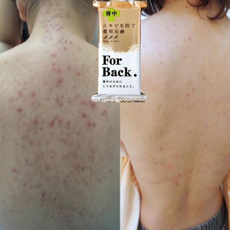 Soap for acne clearance on back