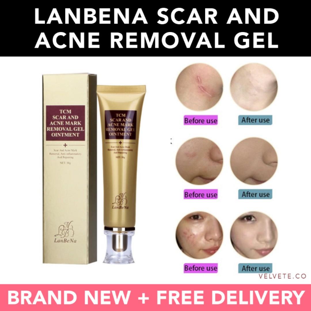 new blackhead removal cream