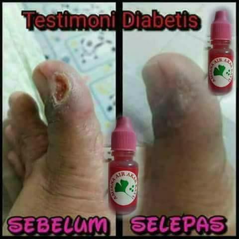 Air Akar Kayu Amirna Diabetis Wounds Health Beauty Makeup On Carousell