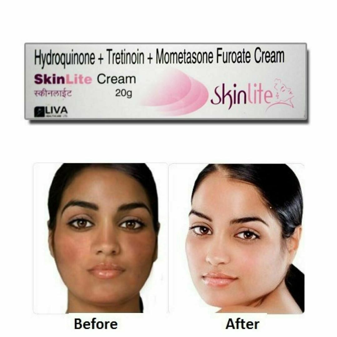 Combo Pack Lightener Brightening Face Underarms Body Peel Anti Inflammatory Hydroquinone Tretinoin Mometasone 20gm Health Beauty Face Skin Care On Carousell Please consult your dermatologist if you observe any of these side effects even in a mild form: combo pack lightener brightening face underarms body peel anti inflammatory hydroquinone tretinoin mometasone 20gm