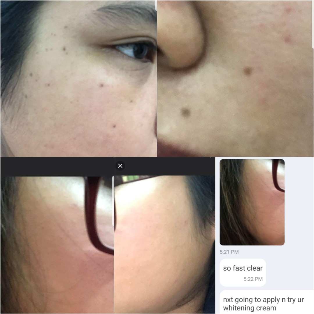 Mole wart milia seed skin tag oilclog scar removal tattoo removal