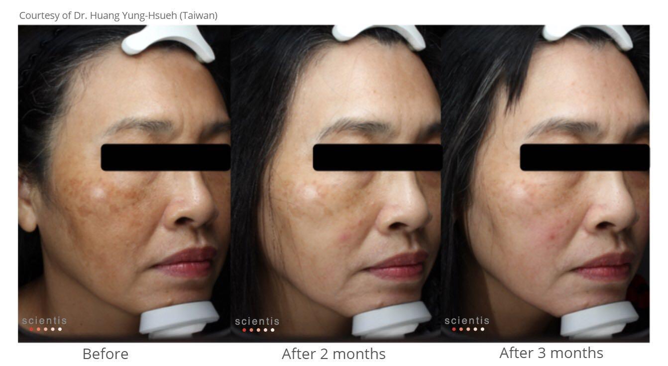 Cyspera (Cysteamine) Pigmentation Cream, Beauty & Personal Care, Face