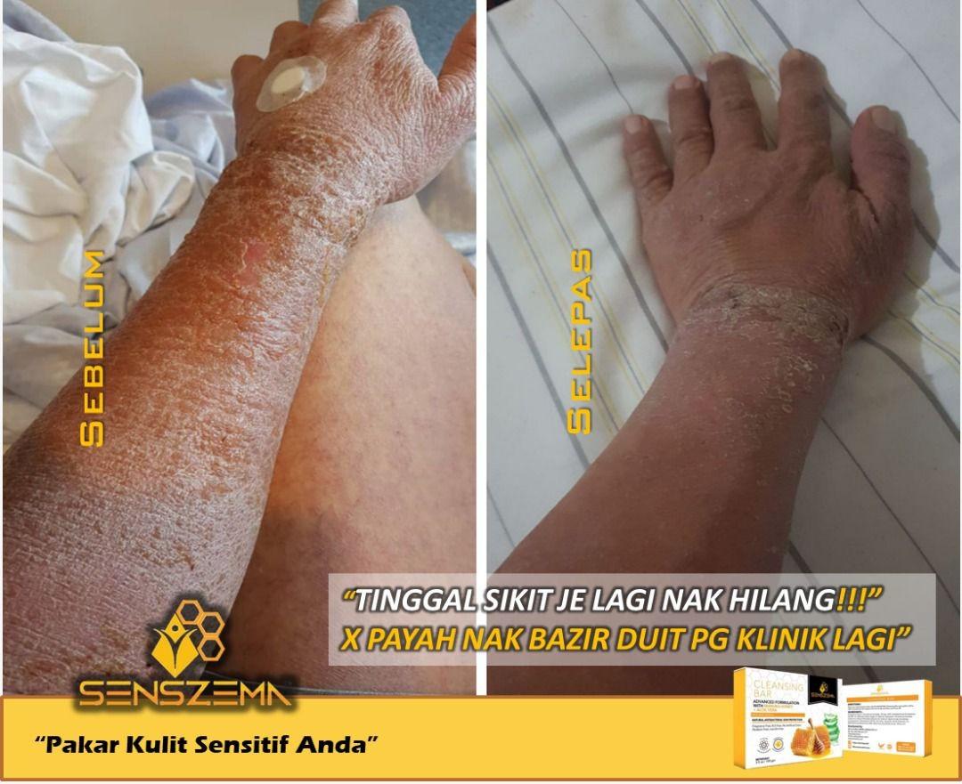 Bar Soap For Eczema Health Beauty Hand Foot Care On Carousell