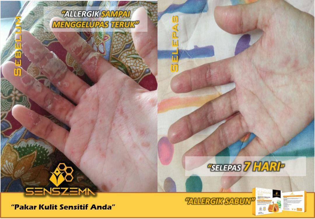 Bar Soap For Eczema Beauty Personal Care Foot Care On Carousell