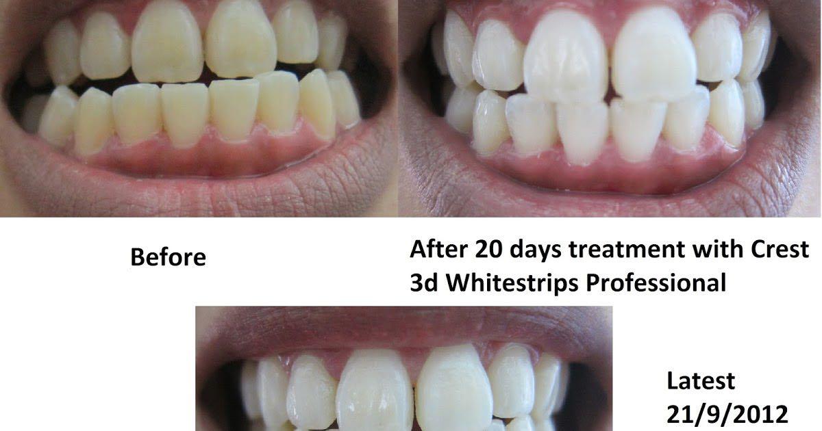 Crest 3d Teeth Whitening Strips Luxe Health Beauty Bath Body