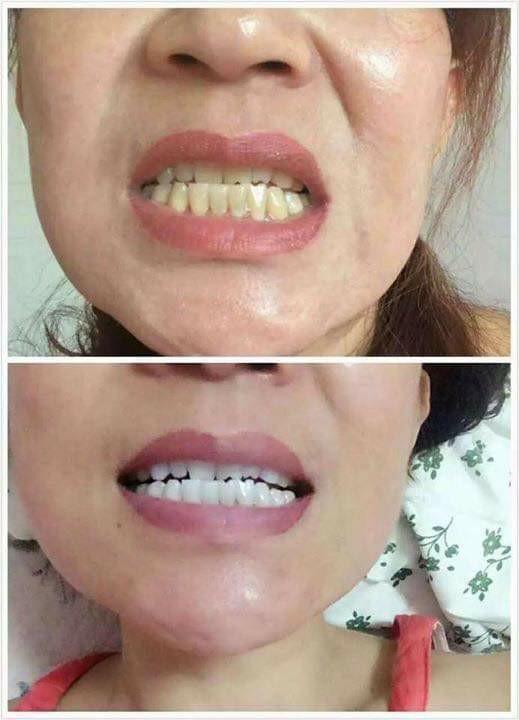 Authentic Vi.aila Teeth Whitening Kit, Beauty & Personal Care, Face