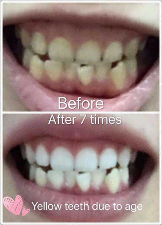 Authentic Vi.aila Teeth Whitening Kit, Beauty & Personal Care, Face