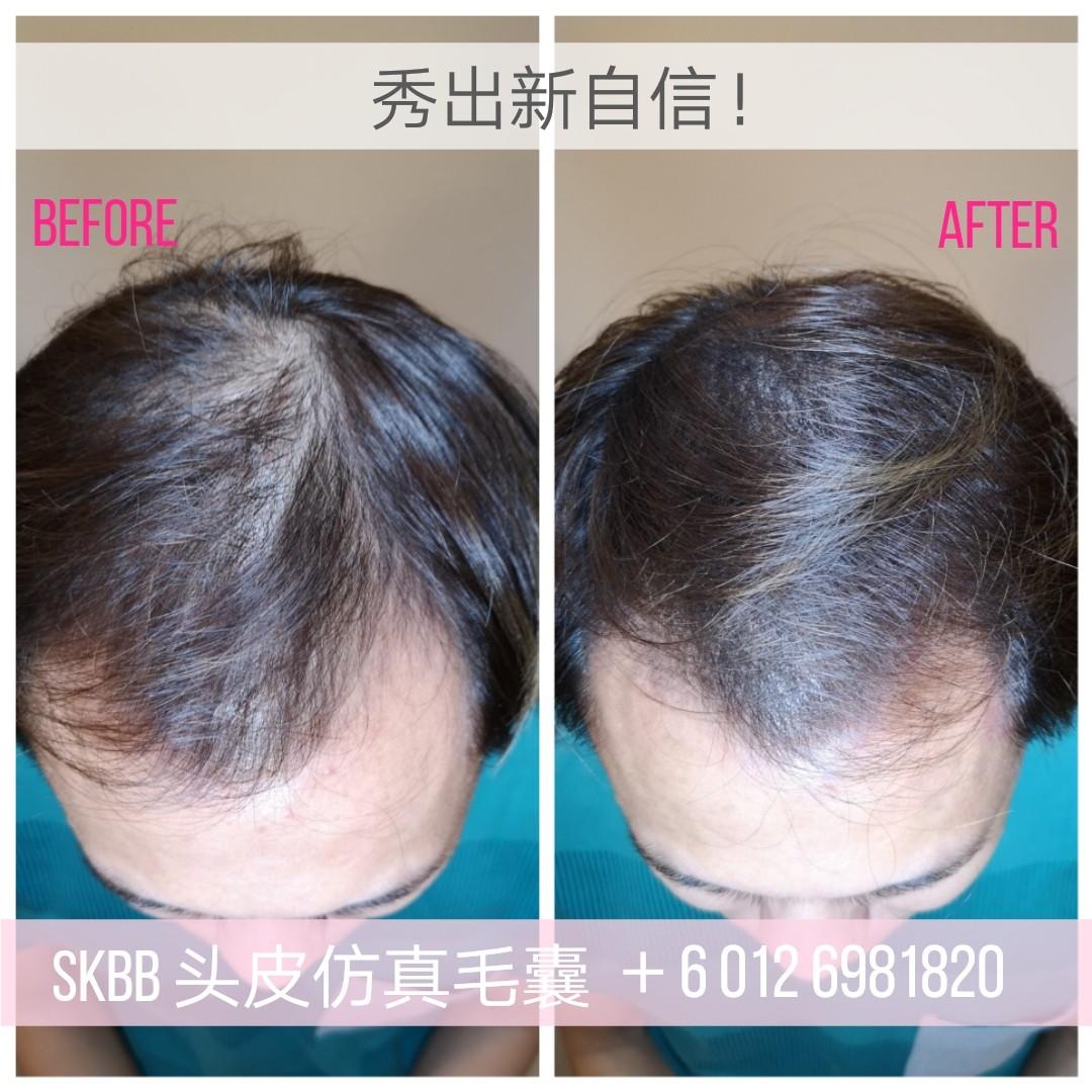 Skbb Hair Follicle Simulation Hairloss Solution Health Beauty
