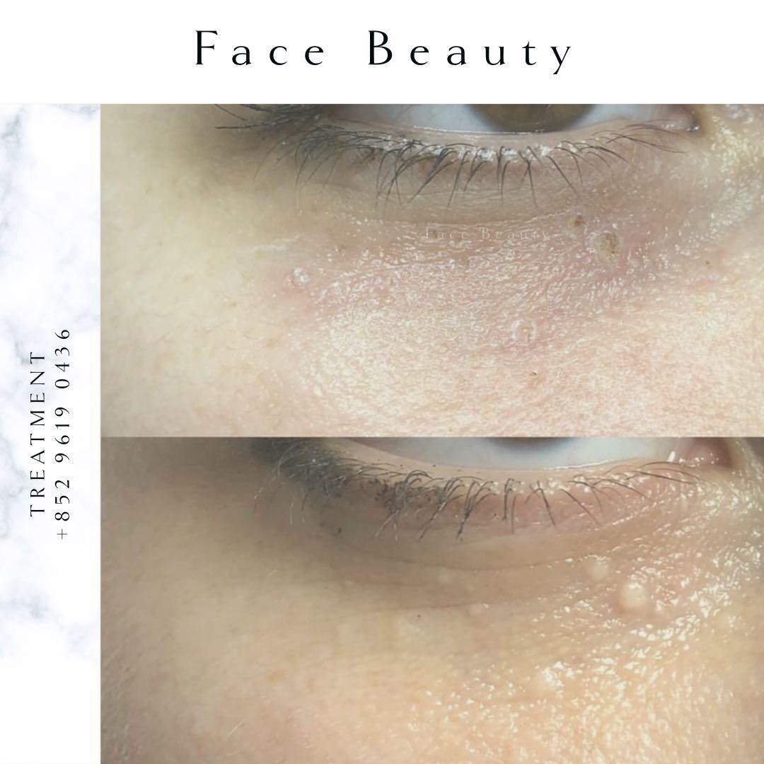 暗粒油脂粒全臉 1600 美容 化妝品 皮膚護理 Carousell