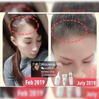 Hair growth ( Forehead Hairline) Anti hairloss shampoo 100% Authentic QR code  ⭐️Shampoo 300ml + Hair mask 150ml +  Hair oil 100ml ** Nourish and repair damage  hair