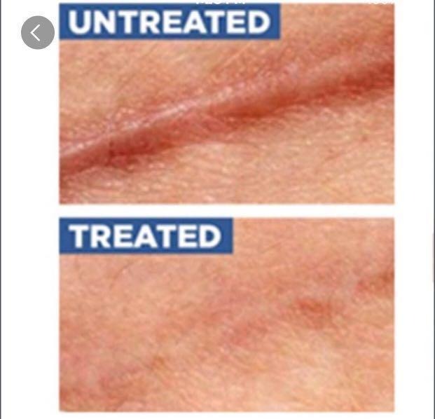 Silicone Scar Removal Patch Solution for any scar [Suitable for Face
