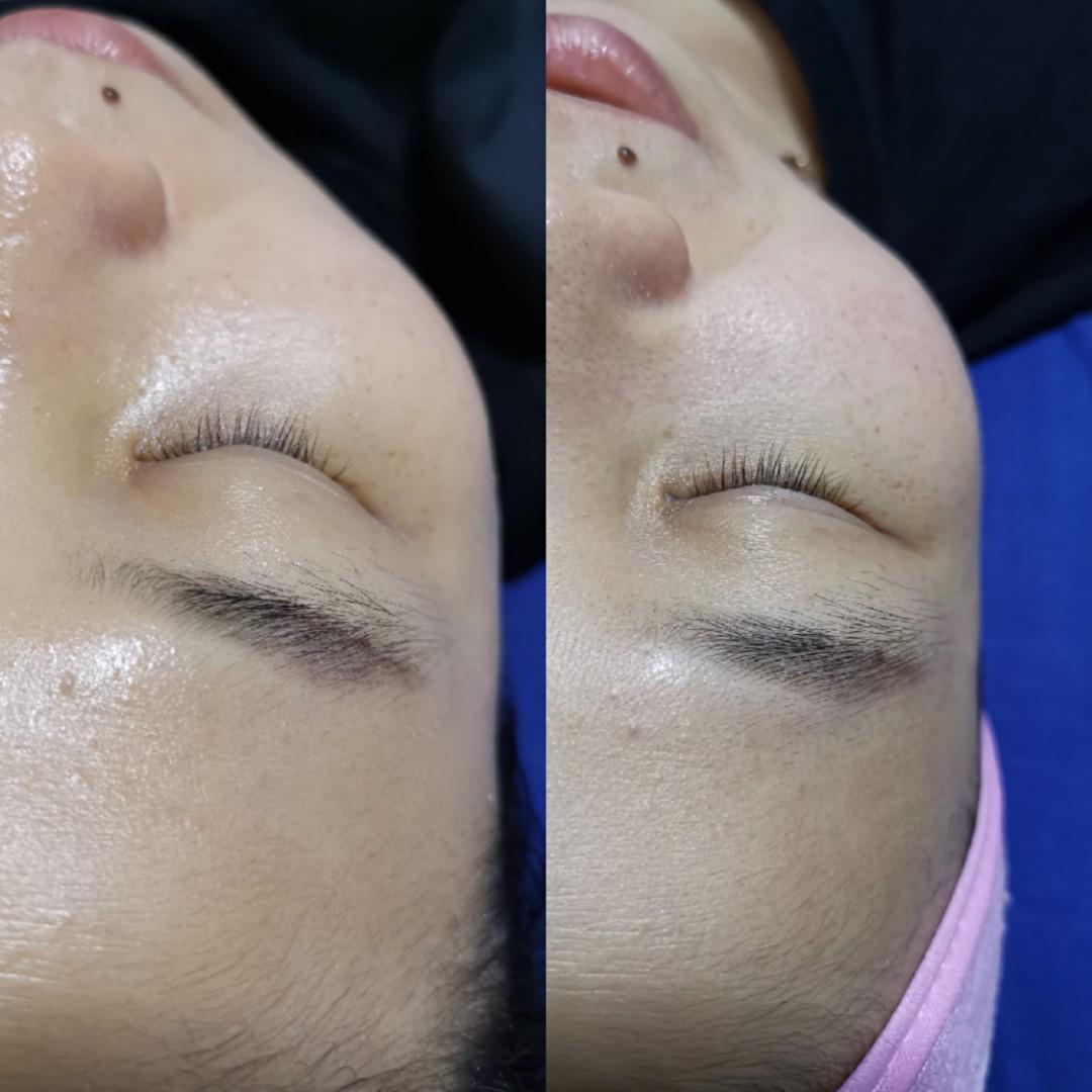 Bb glow skin treatment/facial (Category: Beauty & Health Services) located in Singapore. Submitted by abjoint (Listing ID 279539870, Image 3). Description: First trial $58 (U.P$88) BB glow skin treatment 60mins Location Clementi Ave 6.