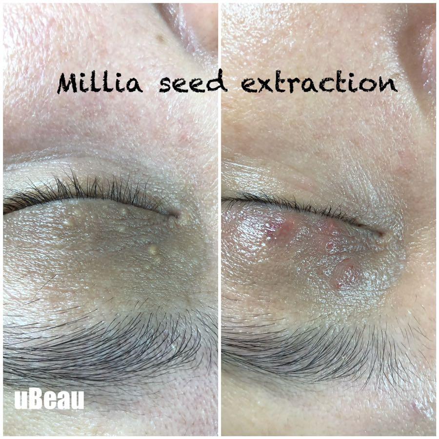 Mole skin tag removal, Beauty & Personal Care, Face, Face Care on Carousell