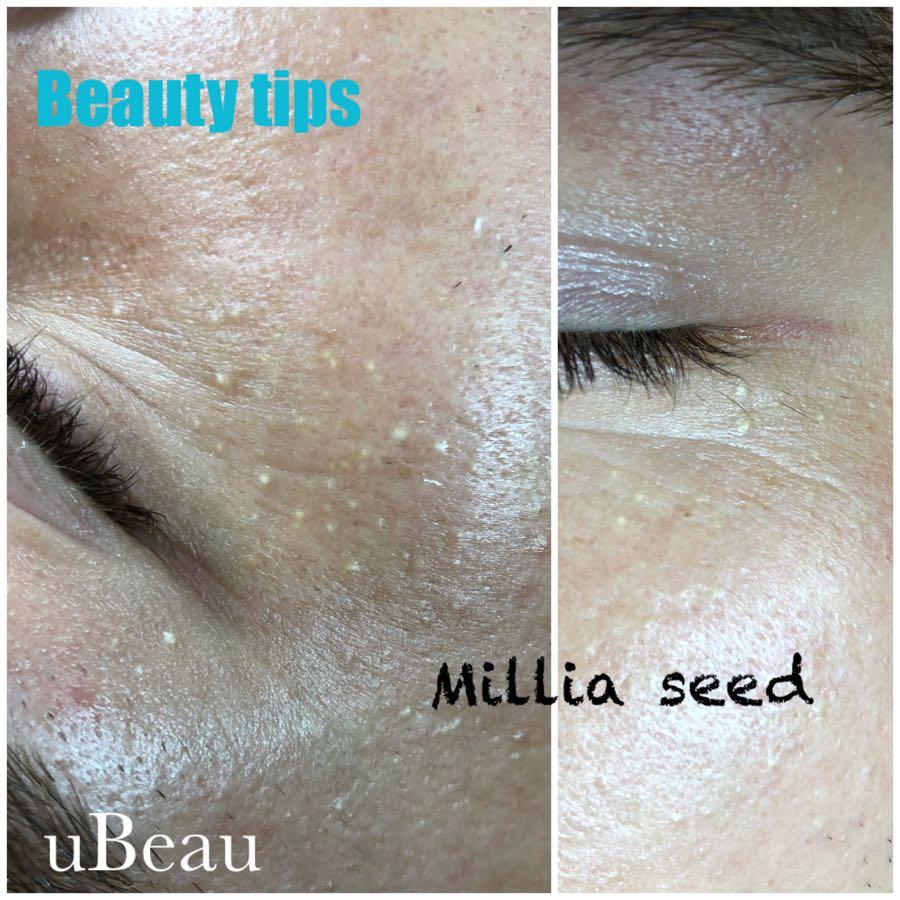 Mole skin tag removal, Beauty & Personal Care, Face, Face Care on Carousell