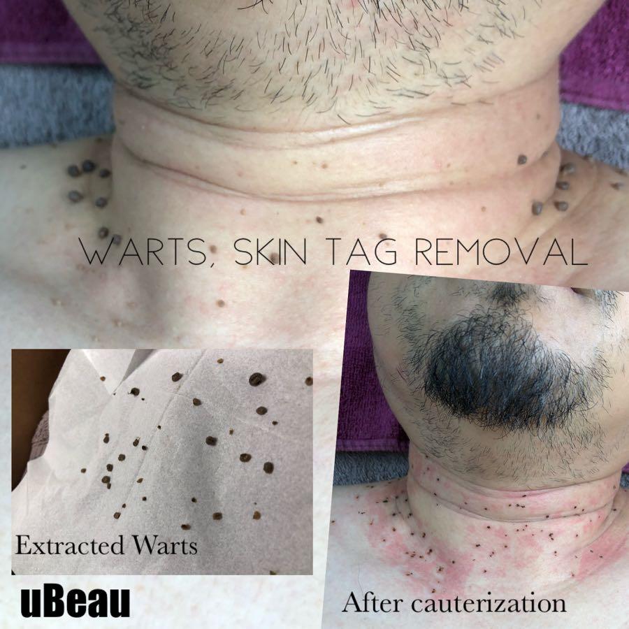 Mole skin tag removal, Beauty & Personal Care, Face, Face Care on Carousell