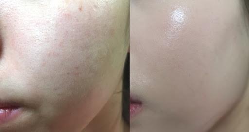 Rejuran Healer Pdrn Treatment Acne Scars Damaged Skin Lifestyle Services Beauty Health Services On Carousell