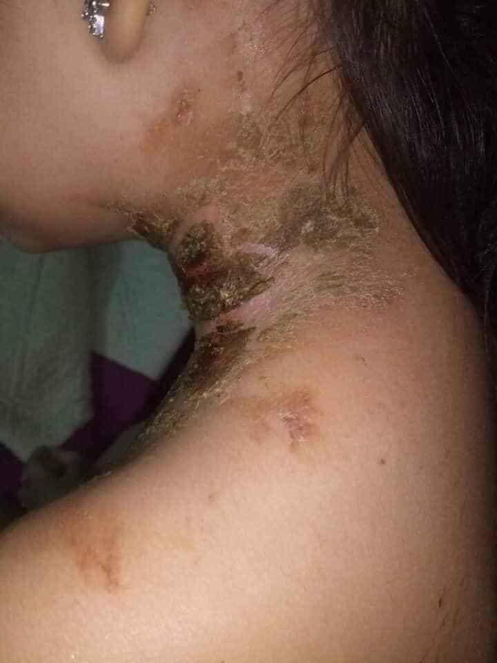 snail mucin eczema