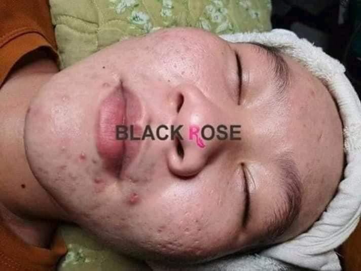 face products for pimples and dark spots