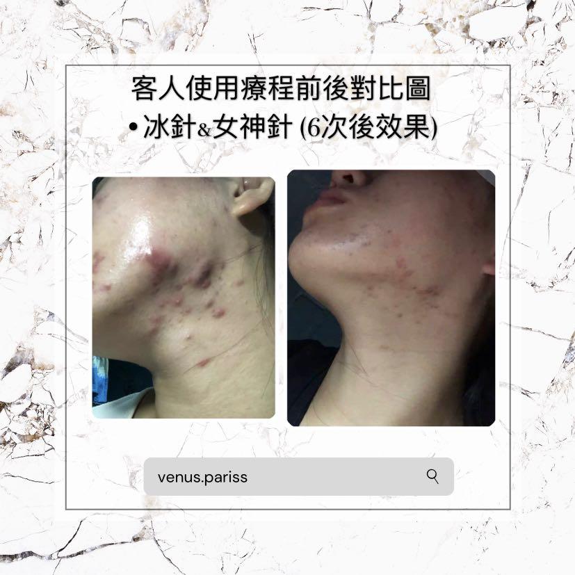 冰針 美容 化妝品 皮膚護理 Carousell