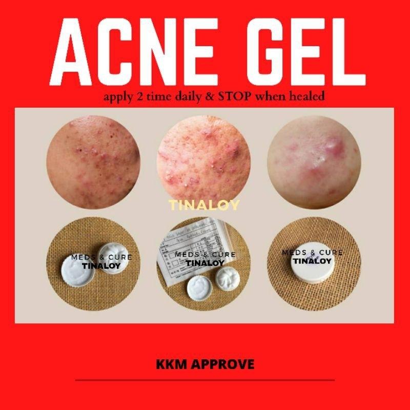 Acne Cream Klinik Kulit Krim Jerawat 5gram Gram Kecantikan Dan Lembab Limited Stock Health Beauty Skin Bath Body On Carousell