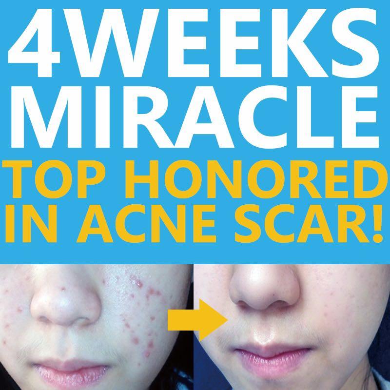 acne scars cream