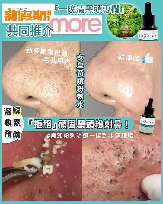 千年石頭瘡好快謝 即晚去濃 Xluxury女皇熱賣產品 奇蹟粉刺水 一晚溶解黑頭 美容 化妝品 皮膚護理 Carousell