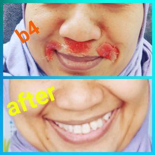Waxing of Upper Lips & Brows