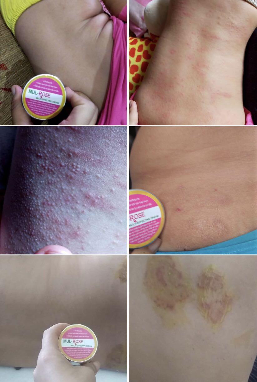 Eczema,scars skin ,dry skin ,skin ithcy,Rash skin Turmeric cream