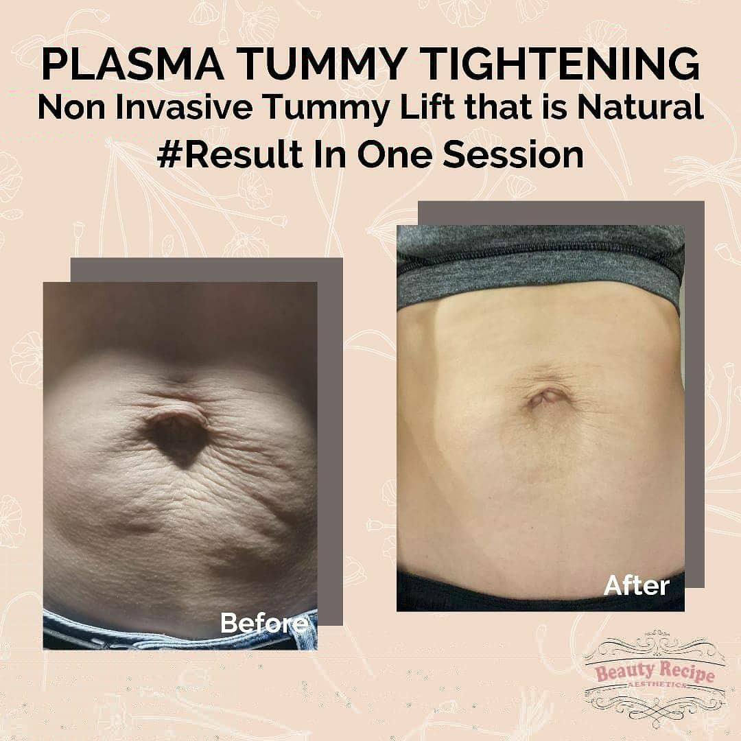 Stomach Tummy Tightening Stretch Marks Removal Plasma Fibroblast Treatment Health Beauty Bath Body On Carousell