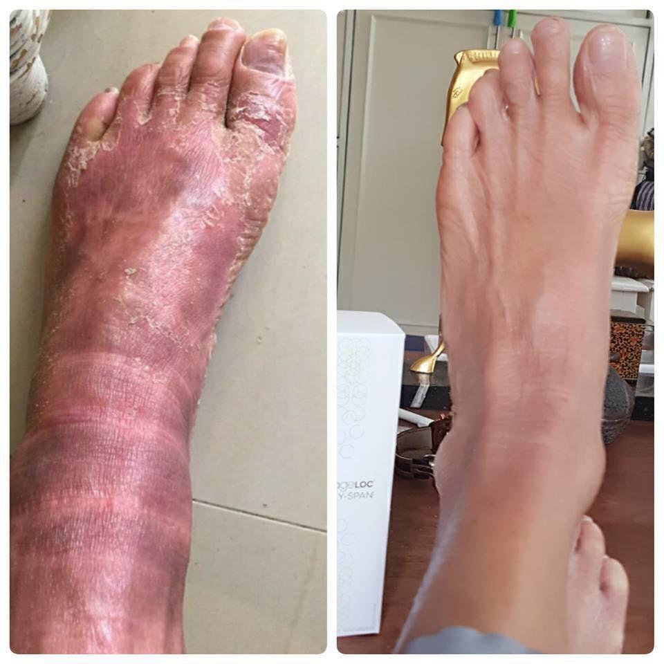 aveeno dermexa psoriasis