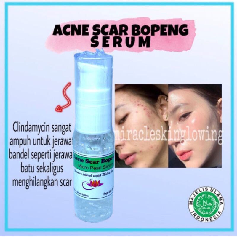 serum untuk acne scar