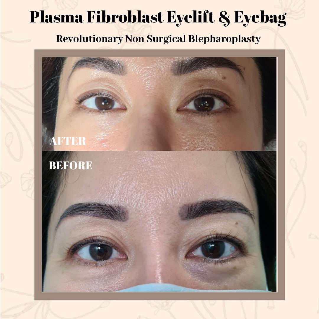 fibroblast plasma