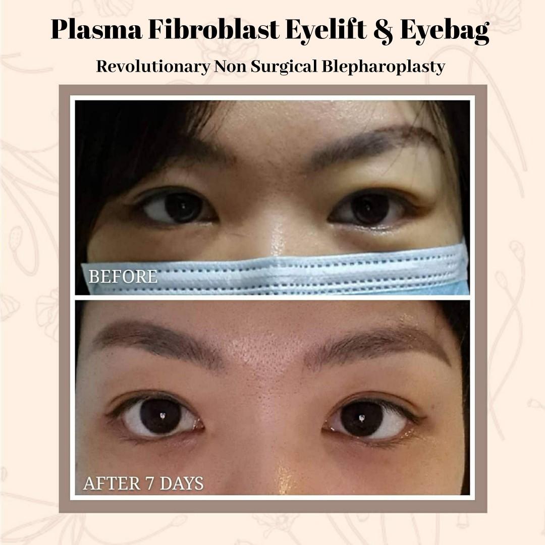 plasma fibroblast near me