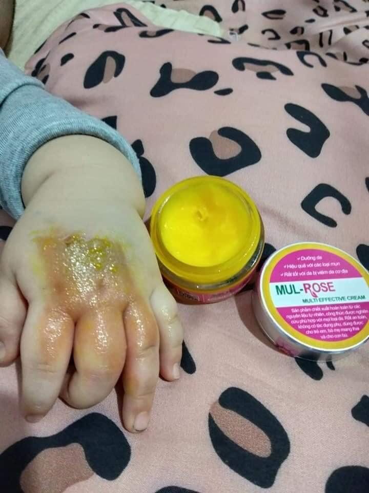 Organic Cream cure burn ,itchy , eczema 30g, Beauty & Personal Care